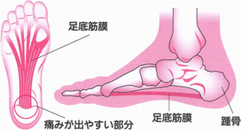 足底筋膜炎2.png