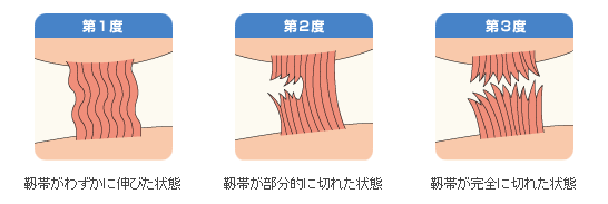 捻挫.png